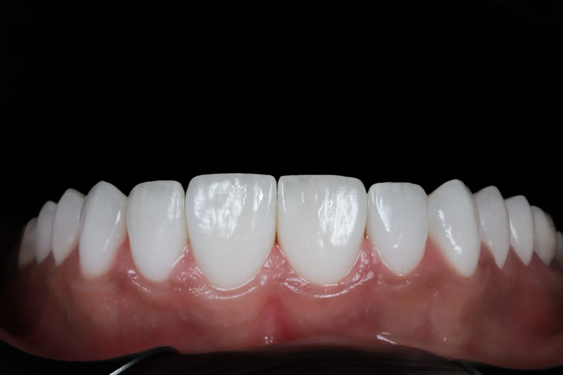 No-prep veneers result photographed at Vigée Dental in Calgary