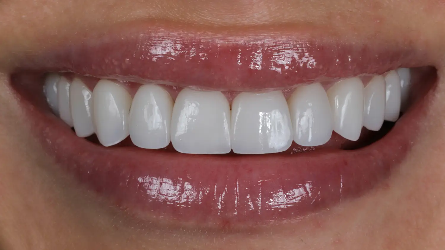 Close-up of porcelain veneers completed at Vigée Dental in Calgary